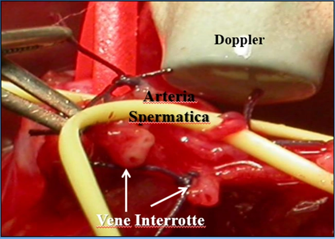 Legatura Arteria con Ecodoppler