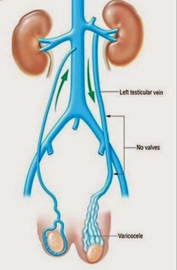 Meccanismo Patogenetico del Varicocele